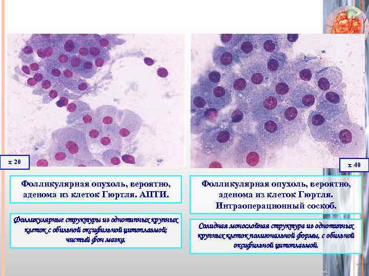 х 20 х 40 Фолликулярная опухоль, вероятно, аденома из клеток Гюртля. АПТИ. Фолликулярные структуры