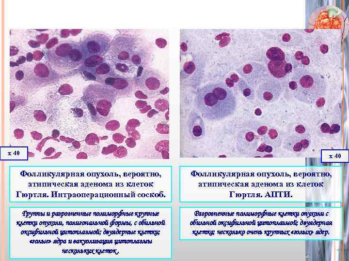 х 40 Фолликулярная опухоль, вероятно, атипическая аденома из клеток Гюртля. Интраоперационный соскоб. Фолликулярная опухоль,