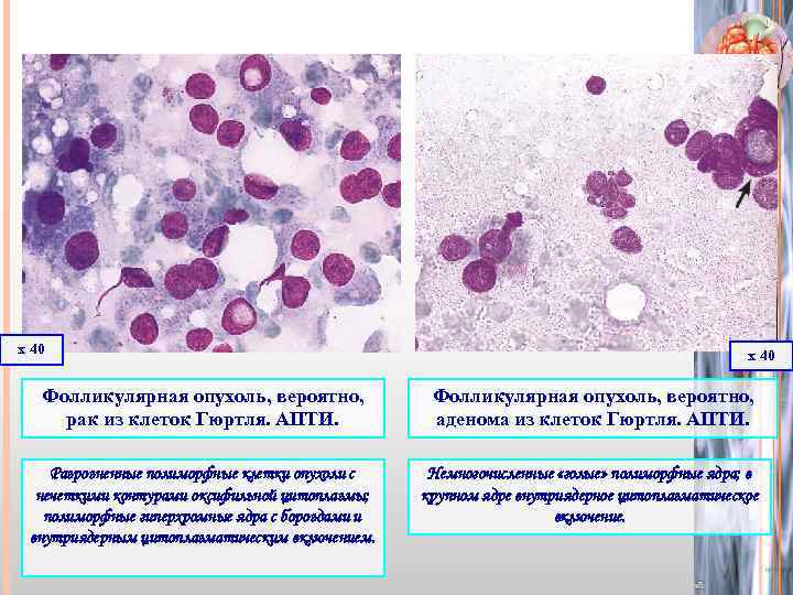х 40 Фолликулярная опухоль, вероятно, рак из клеток Гюртля. АПТИ. Фолликулярная опухоль, вероятно, аденома