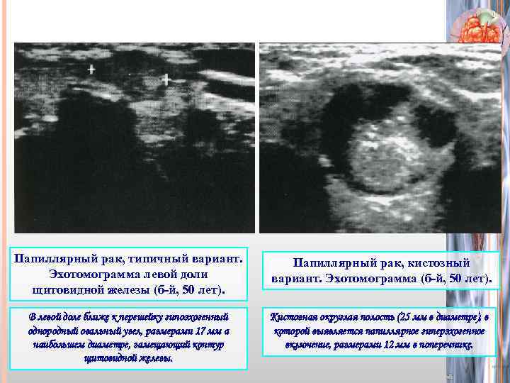 Папиллярный рак, типичный вариант. Эхотомограмма левой доли щитовидной железы (б-й, 50 лет). Папиллярный рак,