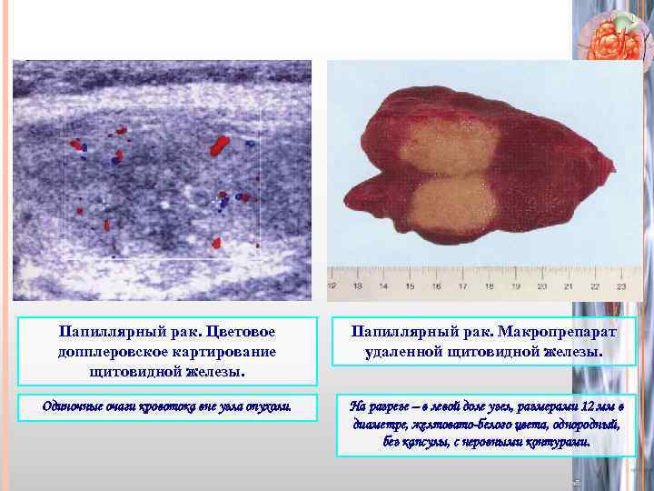 Папиллярный рак. Цветовое допплеровское картирование щитовидной железы. Папиллярный рак. Макропрепарат удаленной щитовидной железы. Одиночные