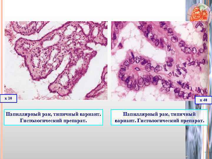х 10 Папиллярный рак, типичный вариант. Гистологический препарат. х 40 Папиллярный рак, типичный вариант.