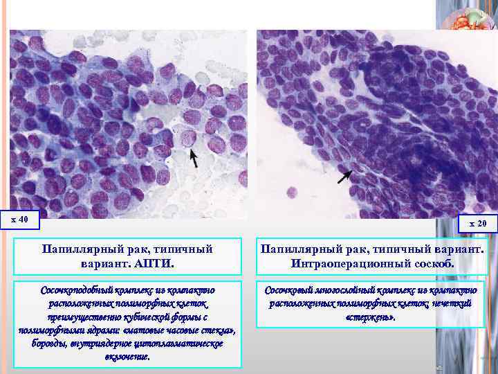 х 40 х 20 Папиллярный рак, типичный вариант. АПТИ. Папиллярный рак, типичный вариант. Интраоперационный