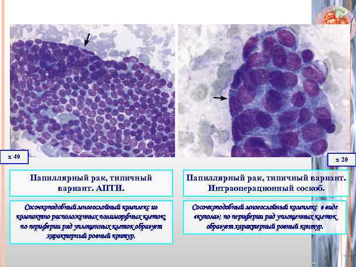 х 40 х 20 Папиллярный рак, типичный вариант. АПТИ. Папиллярный рак, типичный вариант. Интраоперационный