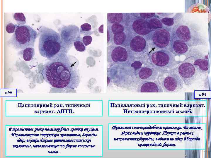 х 90 Папиллярный рак, типичный вариант. АПТИ. Папиллярный рак, типичный вариант. Интраоперационный соскоб. Разрозненные