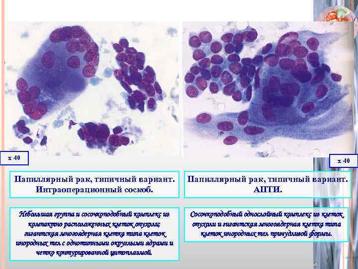 Цитологическая картина фолликулярной опухоли щитовидной железы что значит