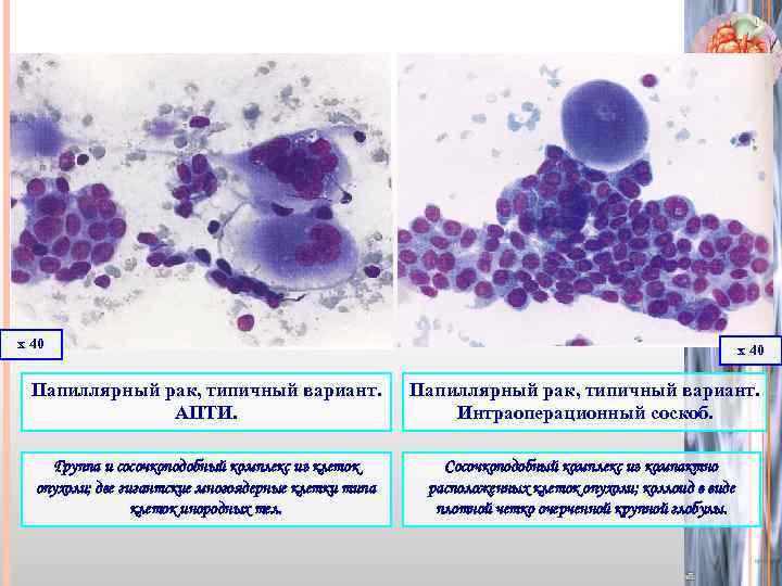 х 40 Папиллярный рак, типичный вариант. АПТИ. Папиллярный рак, типичный вариант. Интраоперационный соскоб. Группа