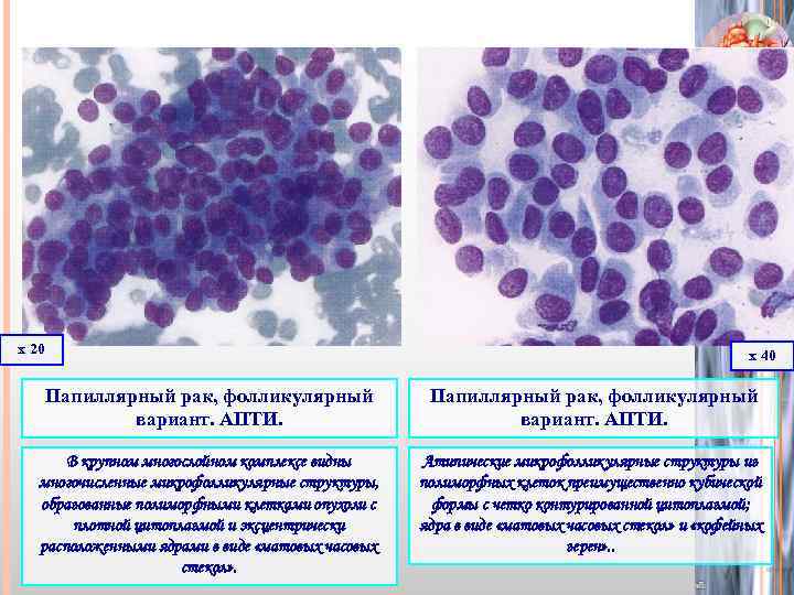 х 20 х 40 Папиллярный рак, фолликулярный вариант. АПТИ. В крупном многослойном комплексе видны