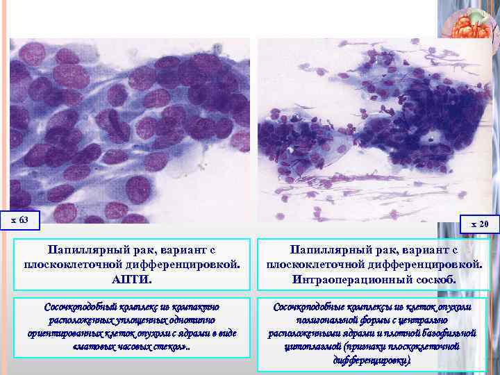 х 63 х 20 Папиллярный рак, вариант с плоскоклеточной дифференцировкой. АПТИ. Папиллярный рак, вариант
