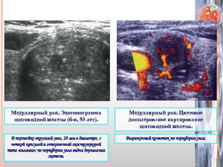 Медуллярный рак. Эхотомограмма щитовидной железы (б-я, 53 лет). Медуллярный рак. Цветовое допплеровское картирование щитовидной