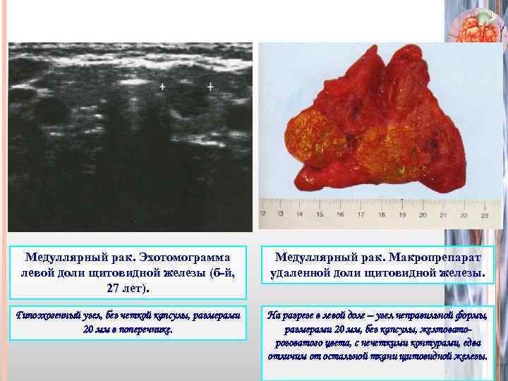 Медуллярный рак. Эхотомограмма левой доли щитовидной железы (б-й, 27 лет). Медуллярный рак. Макропрепарат удаленной