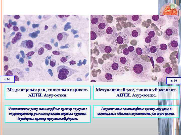 х 63 х 40 Медуллярный рак, типичный вариант. АПТИ. Азур-эозин. Разрозненные резко полиморфные клетки