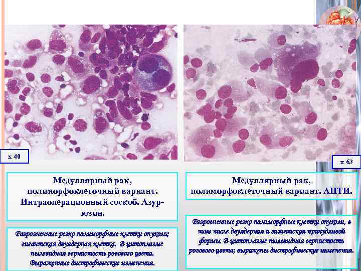 х 40 х 63 Медуллярный рак, полиморфоклеточный вариант. Интраоперационный соскоб. Азурэозин. Разрозненные резко полиморфные