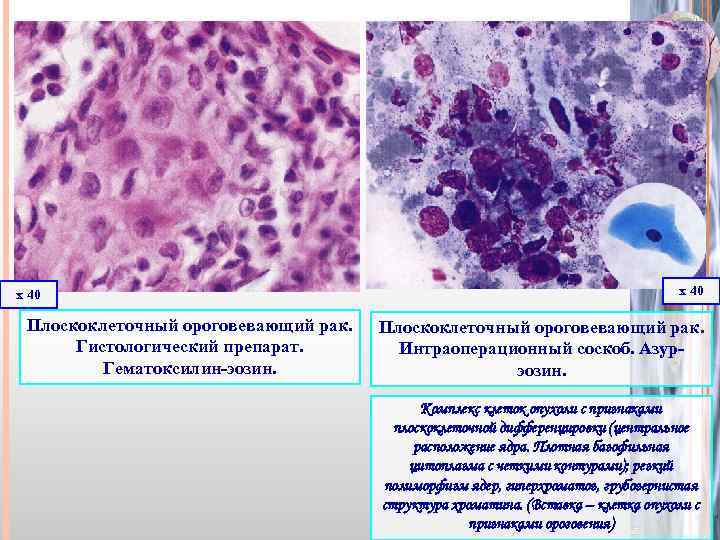х 40 Плоскоклеточный ороговевающий рак. Гистологический препарат. Гематоксилин-эозин. х 40 Плоскоклеточный ороговевающий рак. Интраоперационный