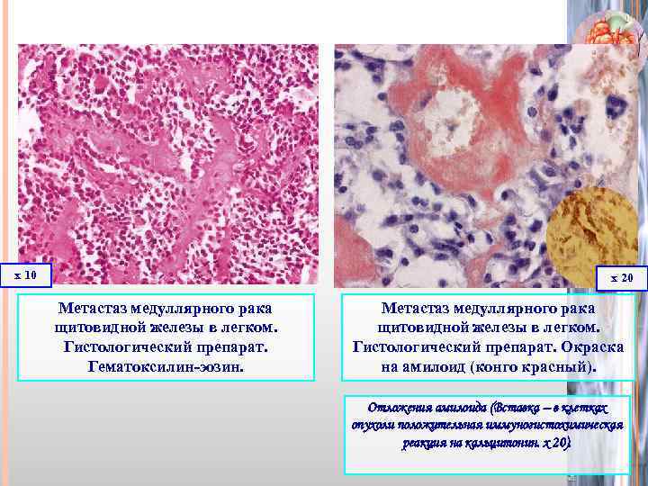 х 10 х 20 Метастаз медуллярного рака щитовидной железы в легком. Гистологический препарат. Гематоксилин-эозин.