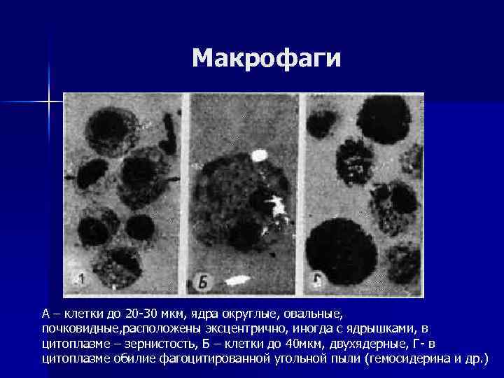 Макрофаги в мокроте фото