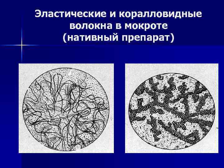 Эластические волокна в мокроте фото