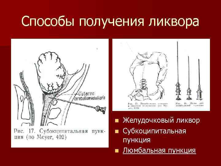 Способы получения ликвора Желудочковый ликвор n Субкоципитальная пункция n Люмбальная пункция n 