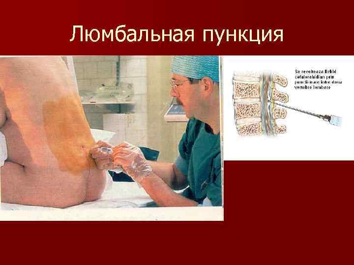 Люмбальная пункция 