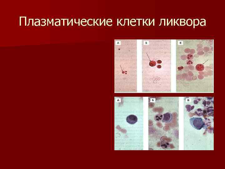 Плазматические клетки ликвора 