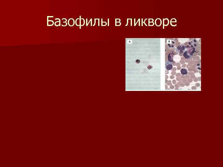 Базофилы в ликворе 