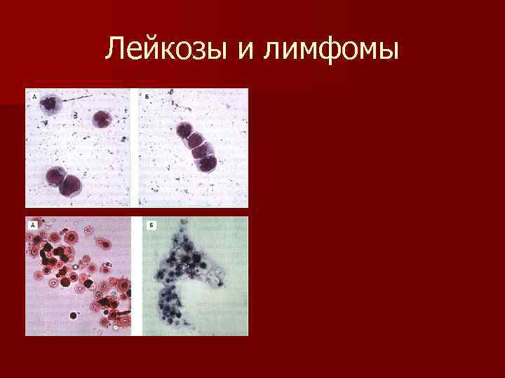Лейкозы и лимфомы 