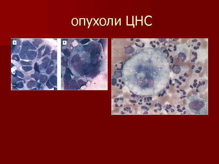 опухоли ЦНС 