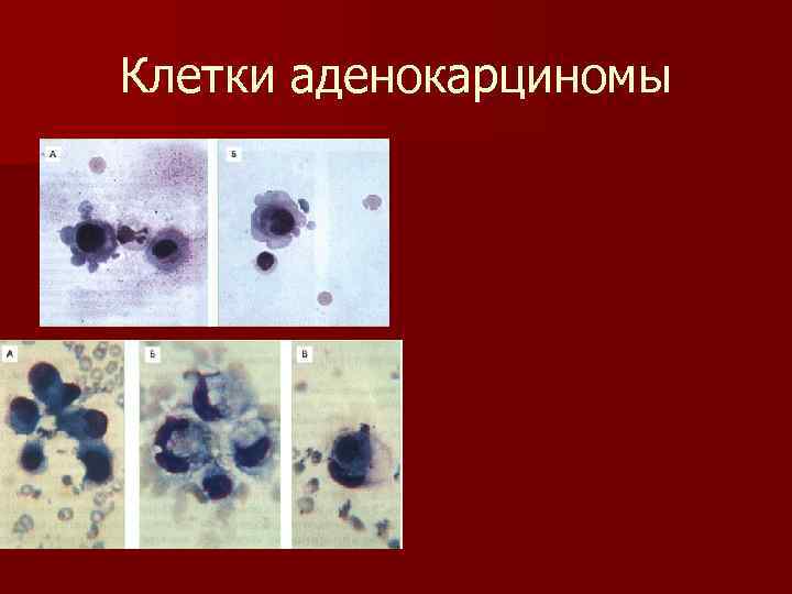 Клетки аденокарциномы 