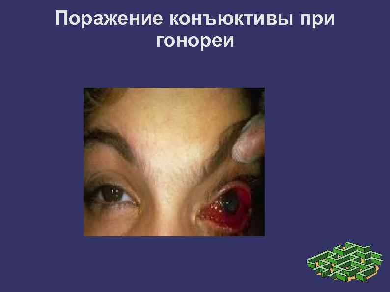 Поражение конъюктивы при гонореи 