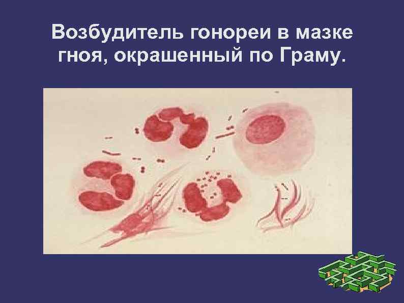 Возбудитель гонореи в мазке гноя, окрашенный по Граму. 