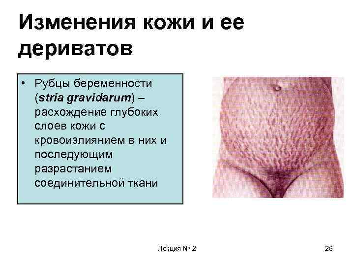 Изменения кожи и ее дериватов • Рубцы беременности (stria gravidarum) – расхождение глубоких слоев