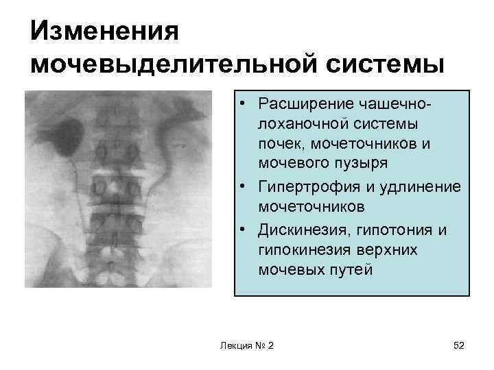 Изменения мочевыделительной системы • Расширение чашечнолоханочной системы почек, мочеточников и мочевого пузыря • Гипертрофия