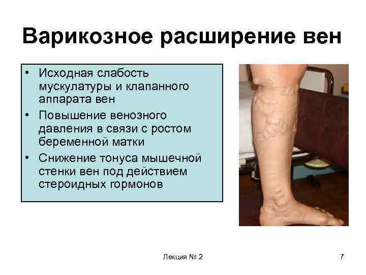 Варикозное расширение вен • Исходная слабость мускулатуры и клапанного аппарата вен • Повышение венозного