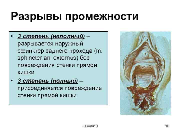 Разрывы промежности • 3 степень (неполный) – разрывается наружный сфинктер заднего прохода (m. sphincter