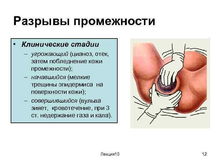 Разрывы промежности • Клинические стадии – угрожающий (цианоз, отек, затем побледнение кожи промежности); –