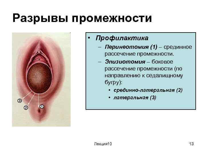 Разрывы промежности • Профилактика – Перинеотомия (1) – срединное рассечение промежности. – Эпизиотомия –