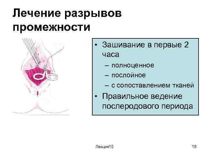 Лечение разрывов промежности • Зашивание в первые 2 часа – полноценное – послойное –