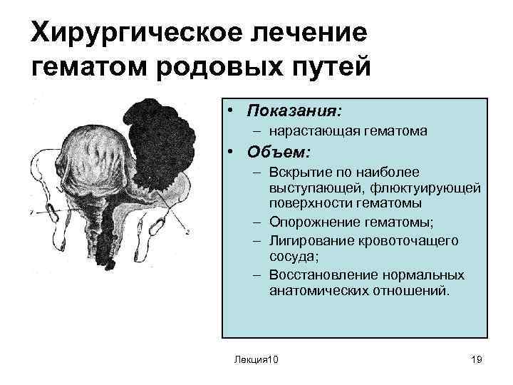 Хирургическое лечение гематом родовых путей • Показания: – нарастающая гематома • Объем: – Вскрытие