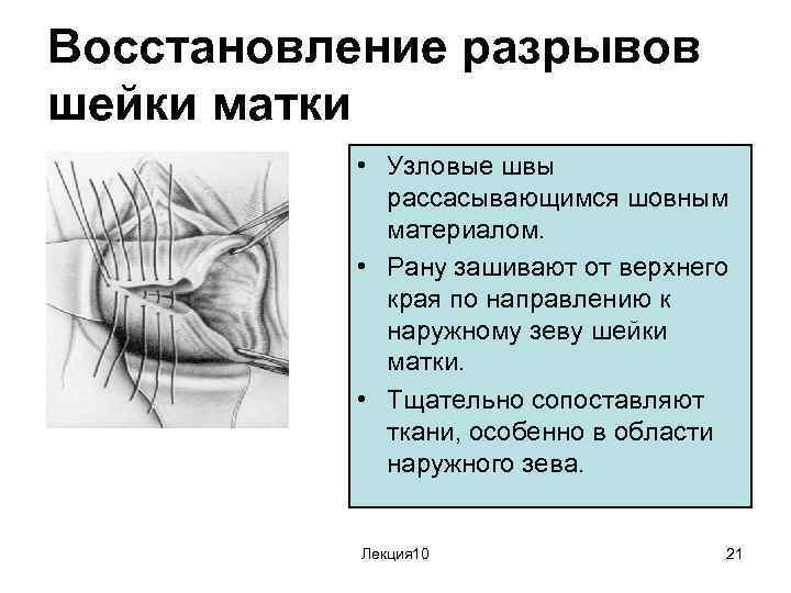 Восстановление разрывов шейки матки • Узловые швы рассасывающимся шовным материалом. • Рану зашивают от