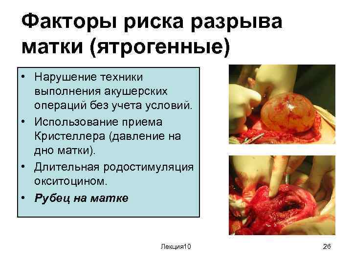 Факторы риска разрыва матки (ятрогенные) • Нарушение техники выполнения акушерских операций без учета условий.