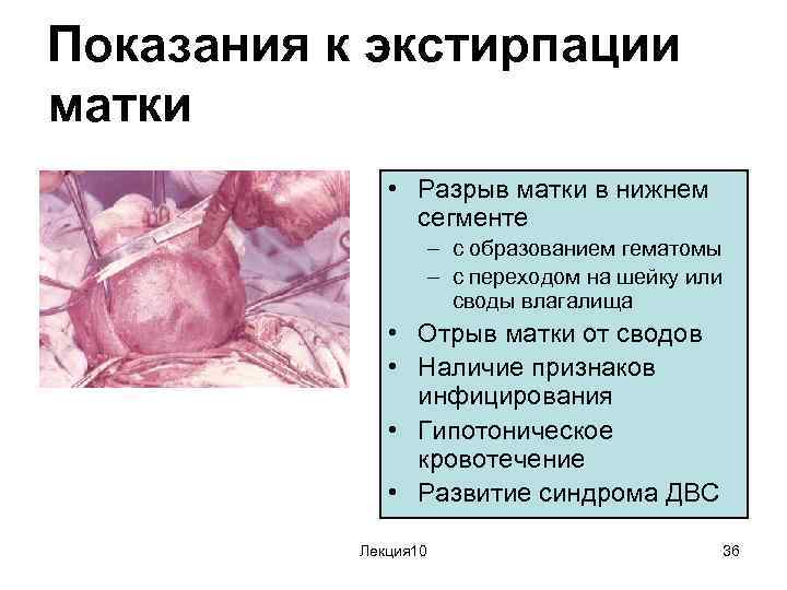 Показания к экстирпации матки • Разрыв матки в нижнем сегменте – с образованием гематомы