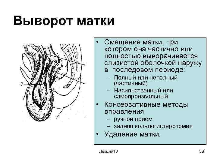 Выворот матки • Смещение матки, при котором она частично или полностью выворачивается слизистой оболочкой