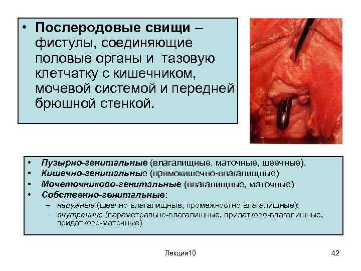  • Послеродовые свищи – фистулы, соединяющие половые органы и тазовую клетчатку с кишечником,