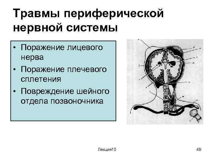 Травмы периферической нервной системы • Поражение лицевого нерва • Поражение плечевого сплетения • Повреждение