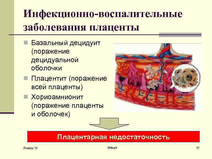 Инфекционно-воспалительные заболевания плаценты n Базальный децидуит (поражение децидуальной оболочки n Плацентит (поражение всей плаценты)