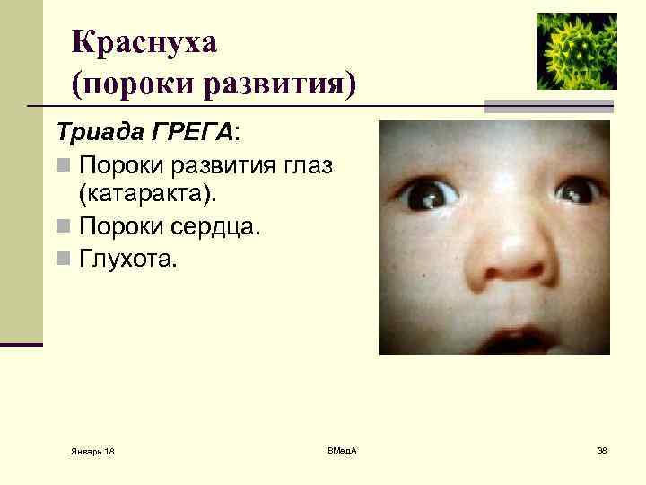 Краснуха (пороки развития) Триада ГРЕГА: n Пороки развития глаз (катаракта). n Пороки сердца. n