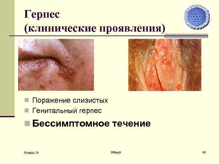 Герпес (клинические проявления) n Поражение слизистых n Генитальный герпес n Бессимптомное течение Январь 18