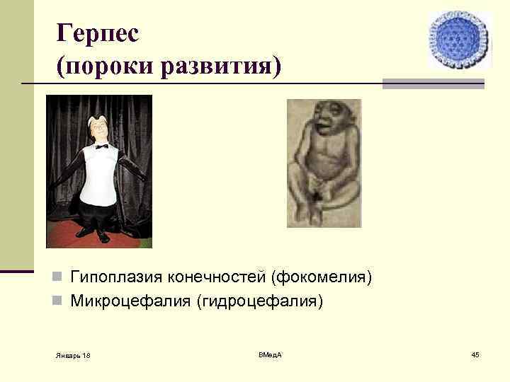 Герпес (пороки развития) n Гипоплазия конечностей (фокомелия) n Микроцефалия (гидроцефалия) Январь 18 ВМед. А