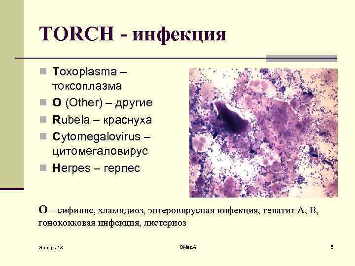 TORCH - инфекция n Toxoplasma – n n токсоплазма O (Other) – другие Rubela