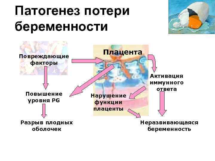 Патогенез потери беременности Повреждающие факторы Повышение уровня PG Разрыв плодных оболочек Плацента Активация иммунного